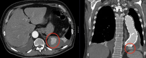 mmagine TC che mostra un endoleak visibile durante il follow-up post-implantazione.