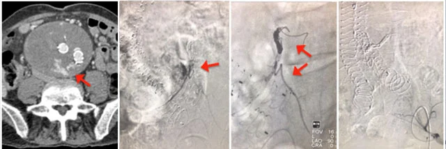 Guida radiologica durante embolizzazione per endoleak di tipo III da disconnessione della protesi