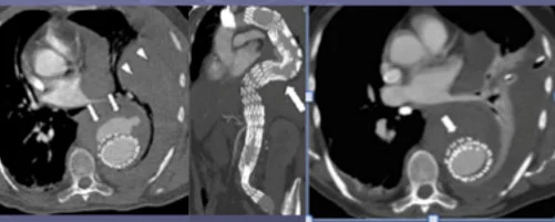 Embolizzazione percutanea per trattamento endoleak sotto guida radiologica