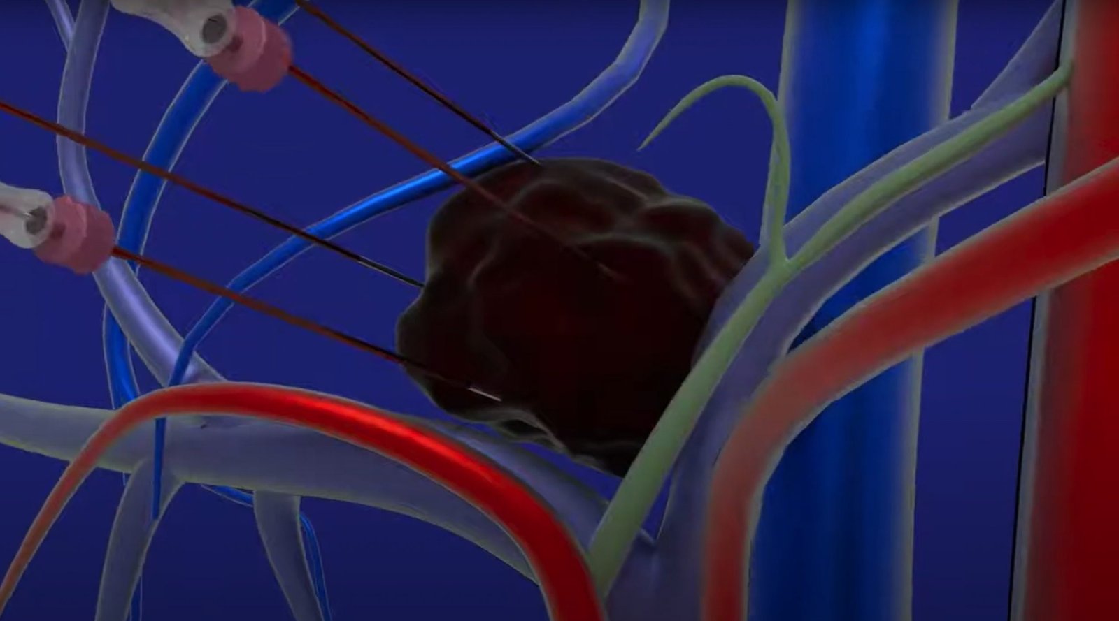 Elettrochemioterapia-1