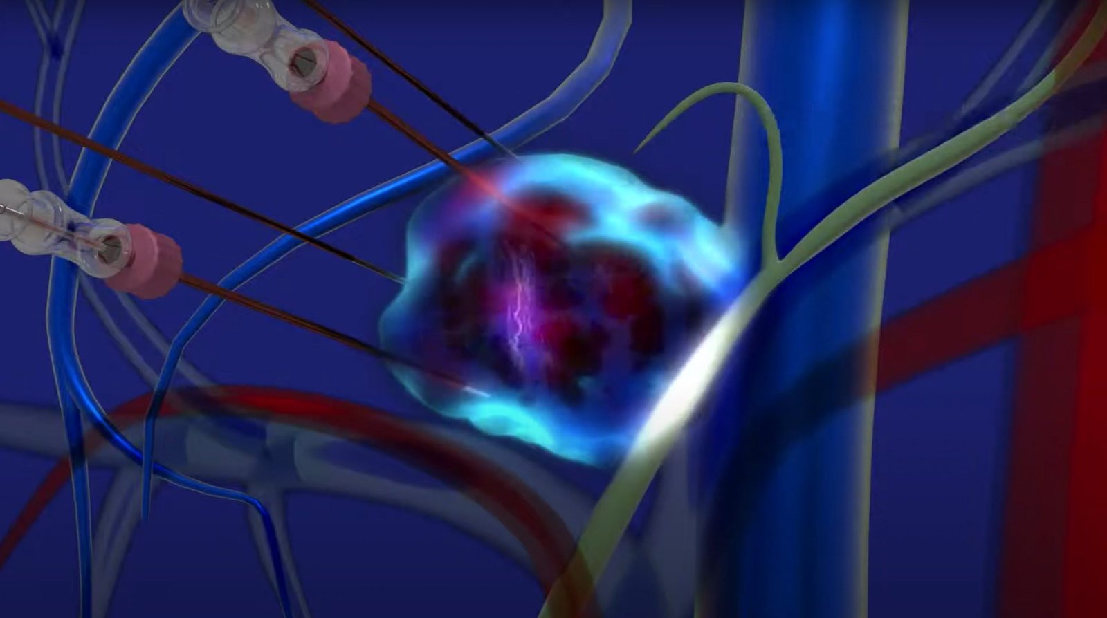 Elettrochemioterapia4-2