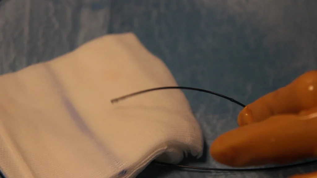 Sala operatoria con radiologo e strumenti per embolizzazione, monitorando la posizione del catetere