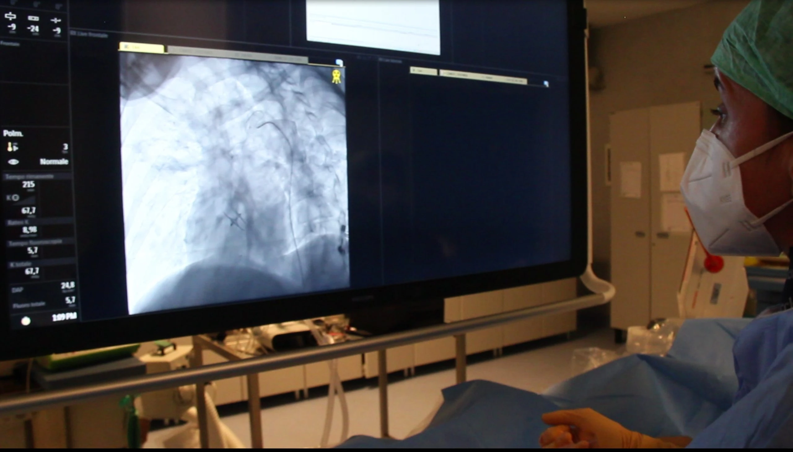 Dettaglio di un catetere che inietta materiale embolizzante durante una procedura di embolizzazione.