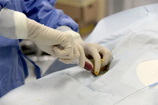 Puntura a mano libera o con guida ecografica.