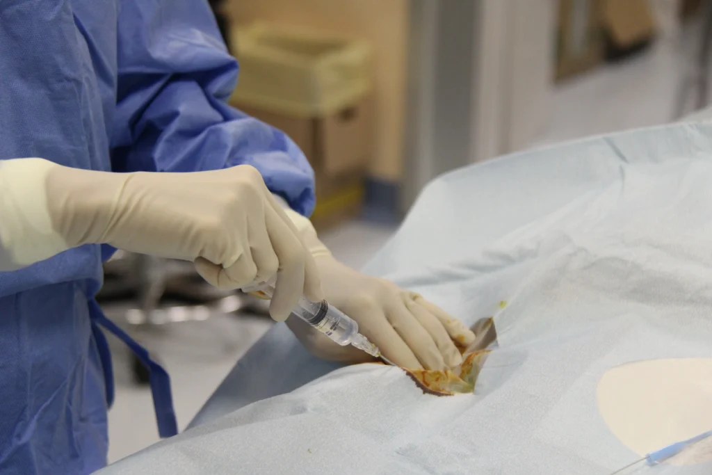 anestesia locale nel sito di puntura.