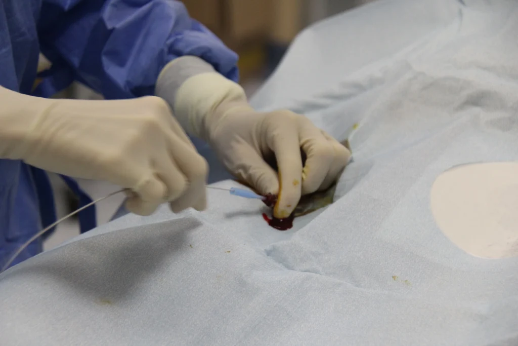 Introduzione del filo guida.