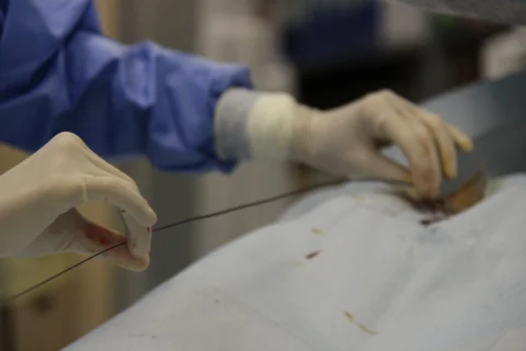 trattamento mini-invasivo oncologico in sala operatoria, radiologia interventistica per il trattamento di tumori con tecniche avanzate