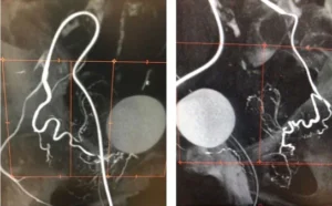 Esecuzione di un intervento radiologico per ipertrofia prostatica benigna