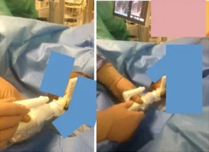 Confronto tra la prostata prima e dopo il trattamento dell'IPB con radiologia interventistica