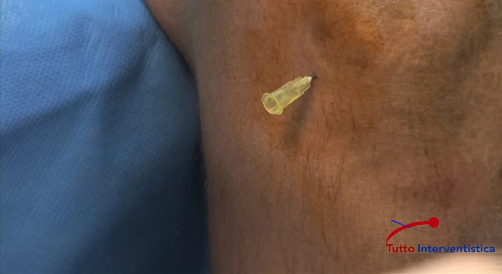 Infiltrazione articolare con anestetico e farmaci antinfiammatori per ridurre il dolore.