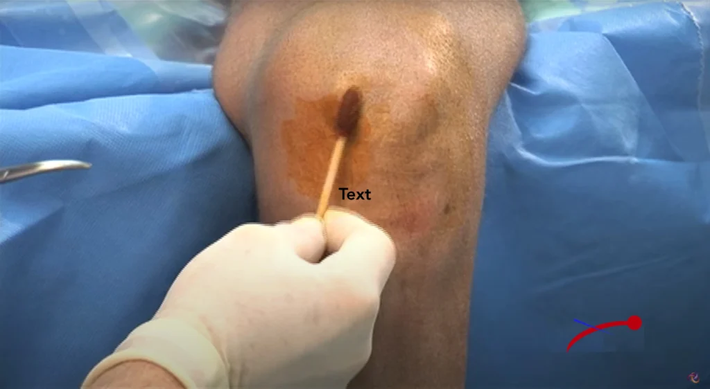 Ecografia per la guida dell'infiltrazione articolare in tempo reale.