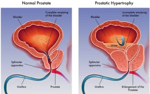 Trattamento con radiologia interventistica per ipertrofia prostatica benigna