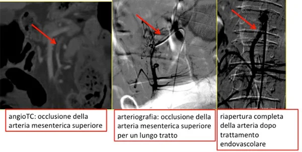 Angiografia delle arterie intestinali durante trattamento di ischemia intestinale acuta