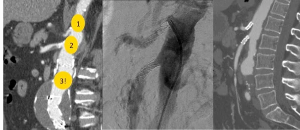 Esecuzione di un trattamento di embolizzazione per ischemia intestinale acuta