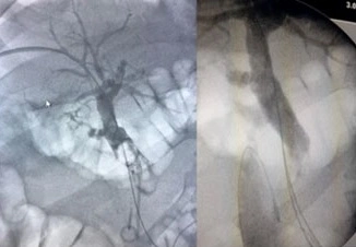 Ecografia del calcolo renale per litotrissia percutanea. Visualizzazione ecografica di un calcolo renale massivo durante la litotrissia percutanea.