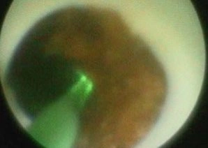 Rimozione dei frammenti di calcolo durante litotrissia percutanea. Rimozione dei frammenti di calcolo renale durante la litotrissia percutanea.