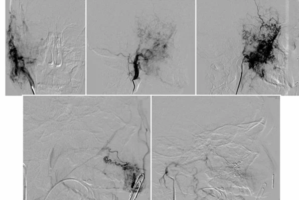 Esecuzione di embolizzazione vascolare per il trattamento delle malformazioni vascolari