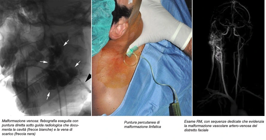 Angiografia delle malformazioni vascolari durante trattamento con radiologia interventistica