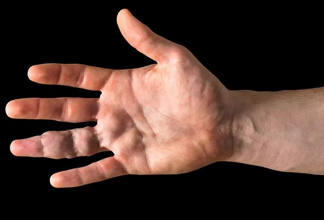 Trattamento delle Malformazioni Vascolari: Approcci Chirurgici e Radiologia Interventistica