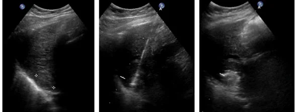 Immagine TAC durante l'ablazione a microonde per il trattamento di un tumore.