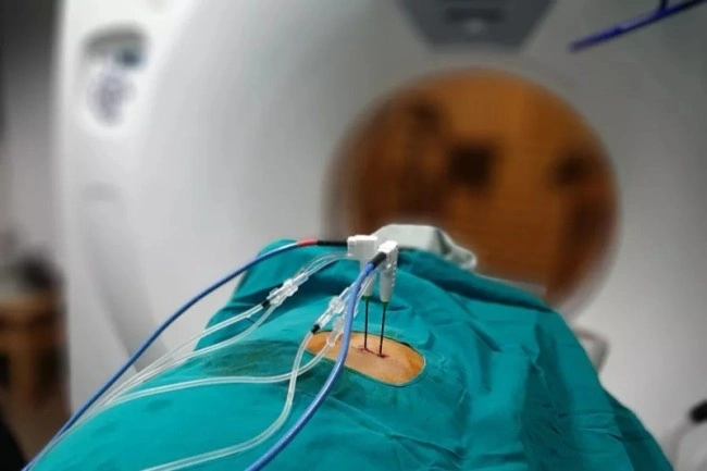 Preparazione della procedura di ablazione a microonde per il trattamento di tumori.