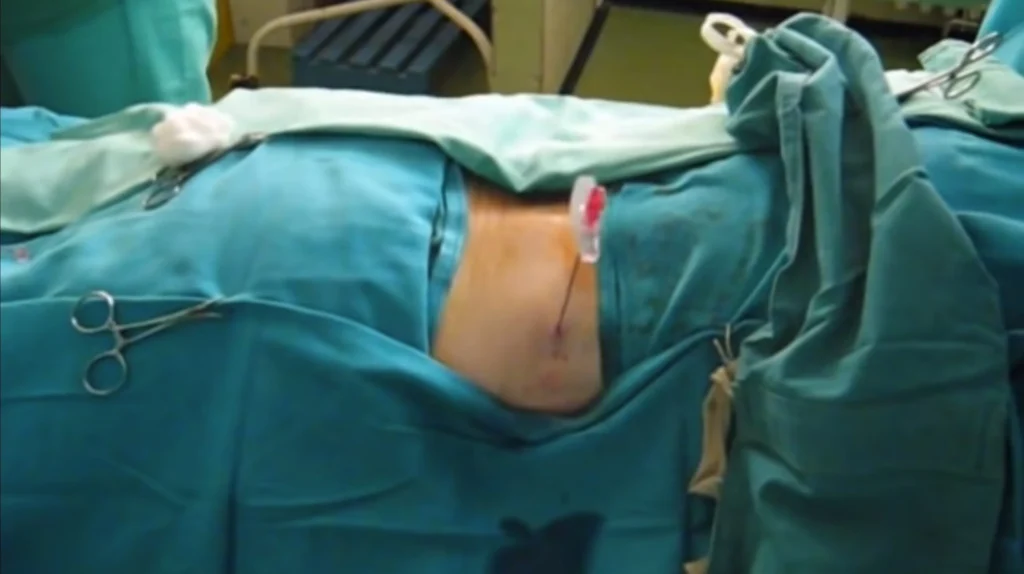 Posizionamento del paziente per nefrostomia percutanea in decubito prono