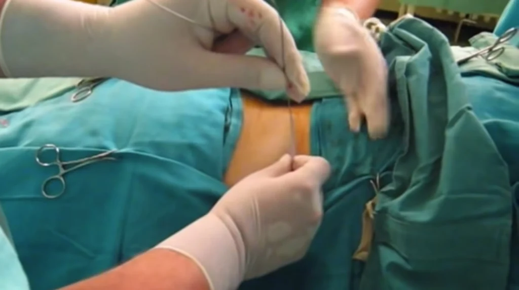 Anestesia locale prima della nefrostomia percutanea