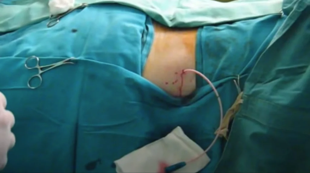 Inserimento del catetere nella cavità renale durante la nefrostomia