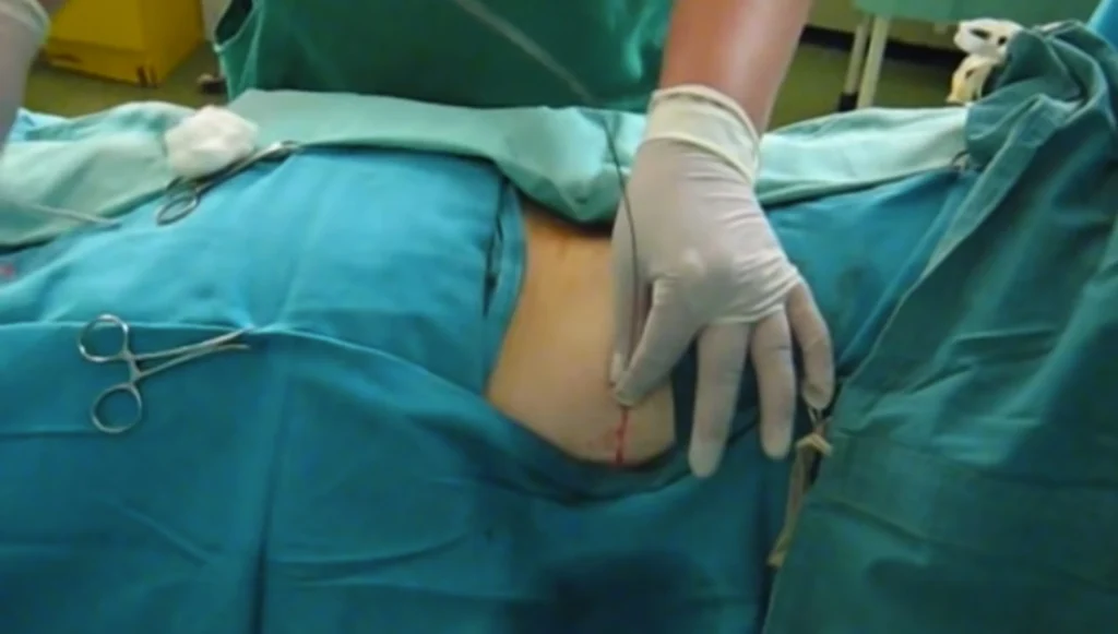 Fissaggio del catetere dopo la nefrostomia