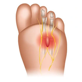 Rappresentazione anatomica del neuroma di Morton con compressione dei nervi interdigitali
