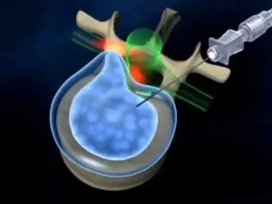 Sonda di nucleoplastica inserita per via percutanea nel disco intervertebrale sotto guida radiologica.