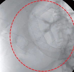 Radiologo che esegue un intervento per l'occlusione intestinale utilizzando tecniche di radiologia interventistica.