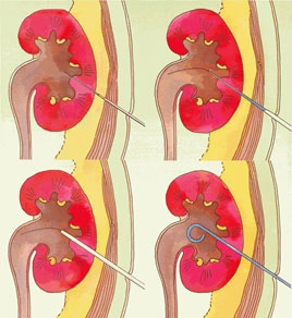 Uropatia ostruttiva, una condizione che ostacola il flusso urinario