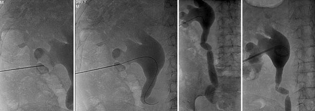 Nefropatia ostruttiva che danneggia il parenchima renale