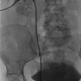 Idroureteronefrosi, dilatazione delle vie urinarie a causa di ostruzioni