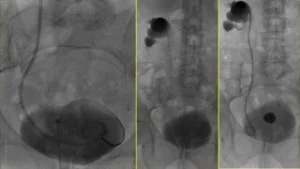 Tecniche diagnostiche per l'ostruzione delle vie urinarie: eco renale e TC