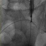Posizionamento stent nefro-vescicale per trattare l'ostruzione urinaria