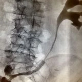 Biopsia mirata sotto guida radiologica per diagnosi precisa