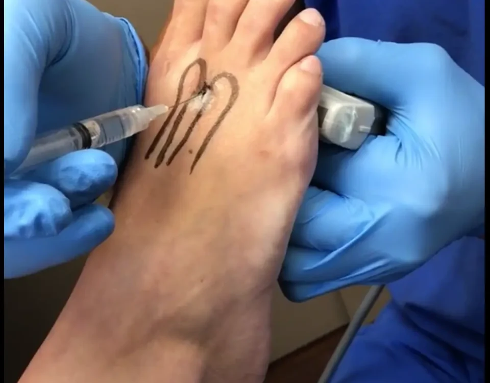 Dolore al piede causato dal neuroma di Morton, con evidenza di formicolio e intorpidimento.