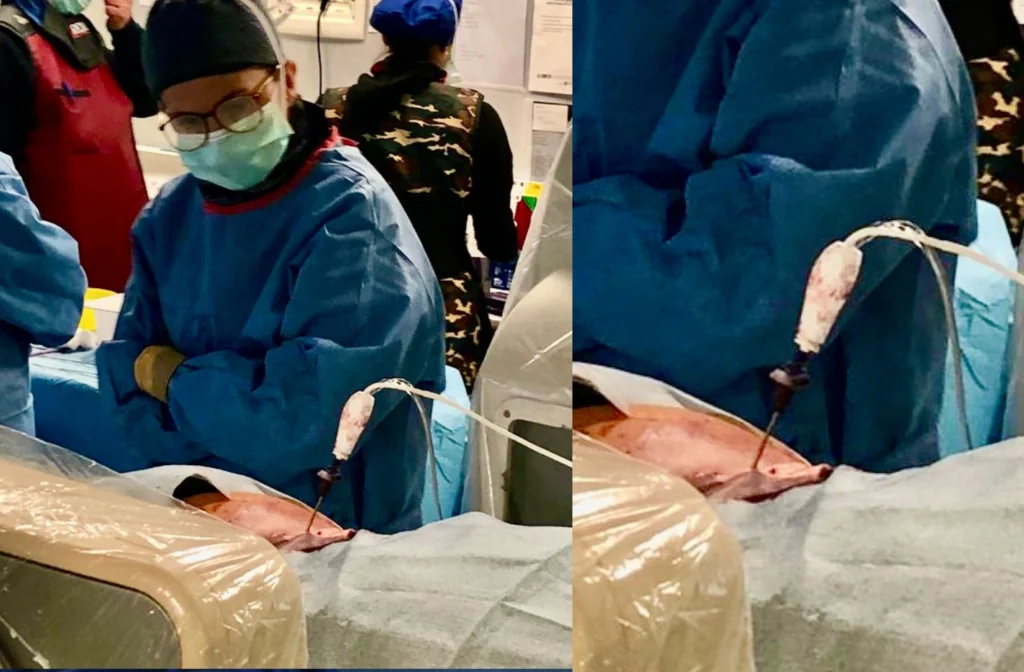 Guida ecografica durante la procedura di ablazione con radiofrequenza (RFA)