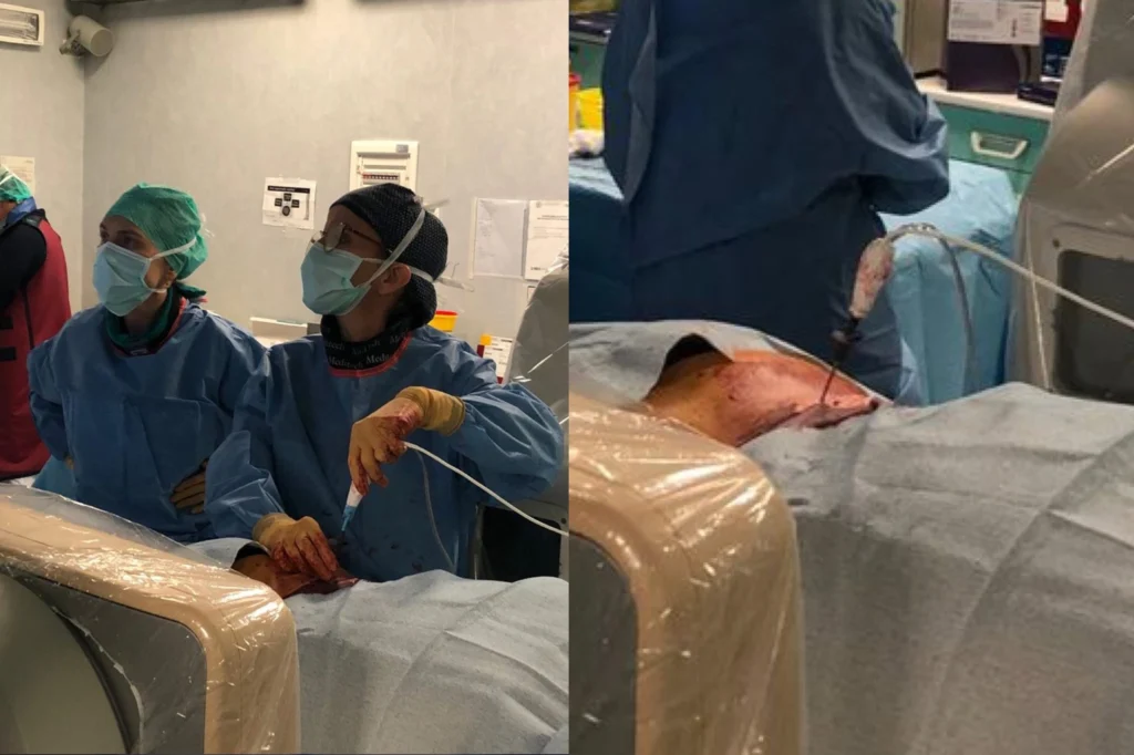 Dispositivo di radiofrequenza per l'ablazione dei tumori