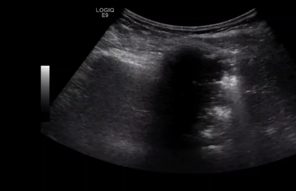 Monitoraggio post-ablazione con RFA tramite esame ecografico