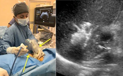 Carcinoma epatocellulare fegato