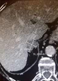 Ecografia che mostra il trattamento di termoablazione per tumore epatico