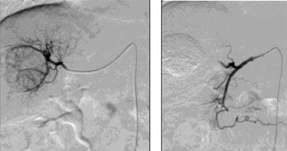 Esiti della termoablazione di lesione paracavale al fegato