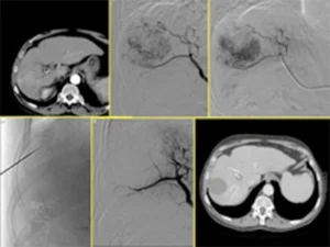 Procedura TACE (chemoembolizzazione trans-arteriosa) per trattamento del carcinoma epatocellulare (HCC)