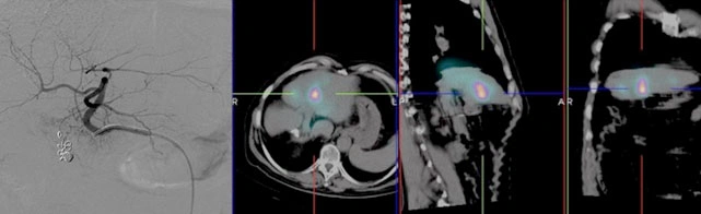 Trattamento combinato di termoablazione e chemoembolizzazione per il tumore epatico