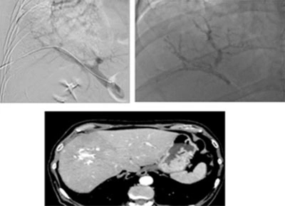 Radioembolizzazione del fegato con microsfere radioattive