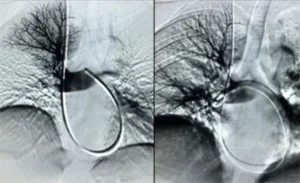 Tromboaspirazione per rimuovere i trombi tramite radiologia interventistica mini-invasiva.