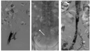 Medico esegue un'ecografia venosa compressiva per diagnosticare la trombosi venosa profonda (TVP)